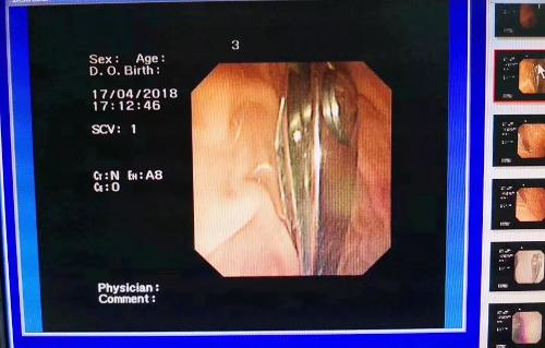 16个月大男宝误吞指甲刀紧急送至a片网站
