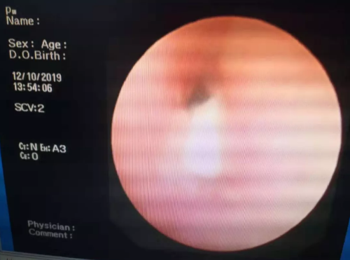 异物卡在这个位置，公主岭2岁女宝左主气道差点被堵死