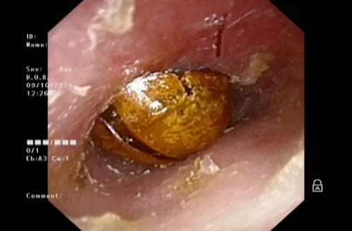 孩子耳朵爬进一只“花大姐”，2天都没掏出来……