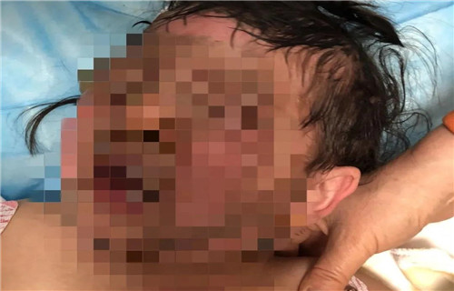 太大意！长春32个月大女宝被火锅III度烫伤