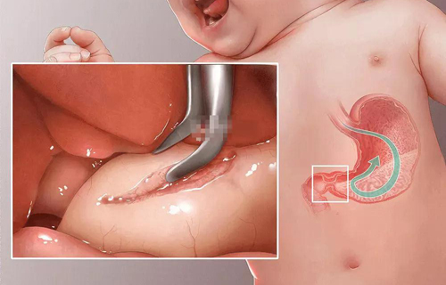 ​这里狭窄，满月宝宝体重不增反降