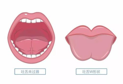1天剪9个，“大舌头”有哪些症状？