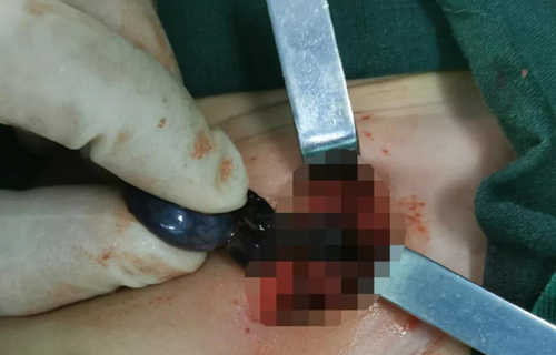 听着都疼！长春8月龄男宝睾丸扭转540度，不得不……