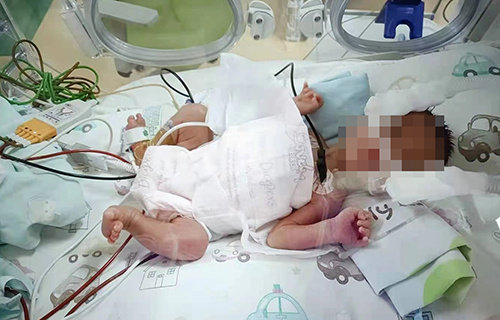 小于1500g早产儿救治成功率超95%