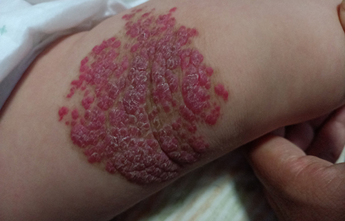 这种“胎记”要赶快治，当心是瘤！