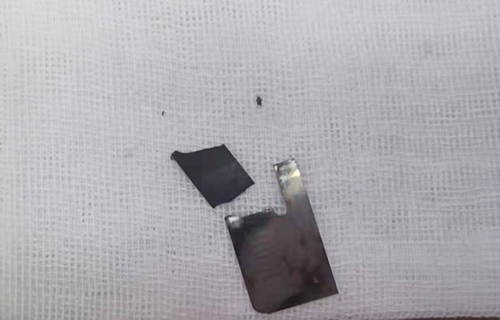 险！11岁女孩吞下2枚刀片