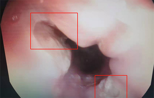 13岁男孩的腹痛之谜解开了