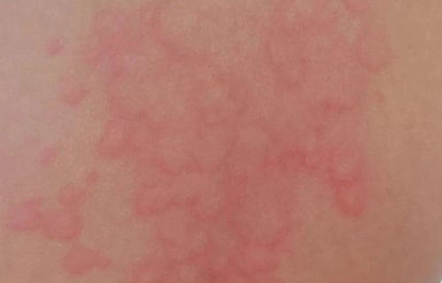 解决“荨麻疹宝宝”的烦恼