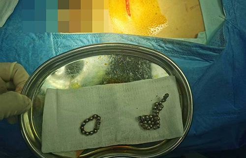 熊孩子“花样”闯祸，外科医生妙手解决“难言之隐”