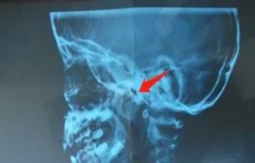 孩子腺样体肥大，该不该做手术？