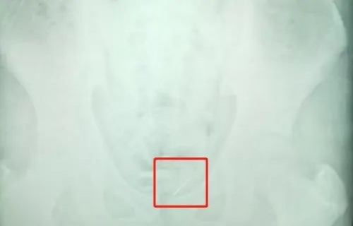 惊！吉林市13岁男孩将4厘米缝衣针插入尿道