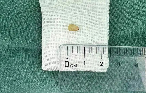 1岁半女童支气管呛入异物 “京长”儿医携手助其脱离险境