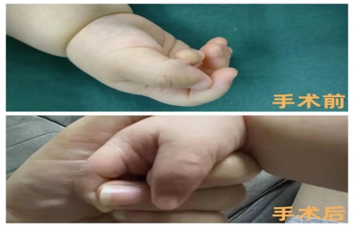 六个月宝宝“特殊多指”，a片网站
巧解难题