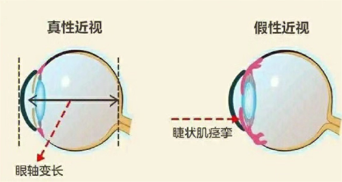 真性近视？假性近视？该如何区分？