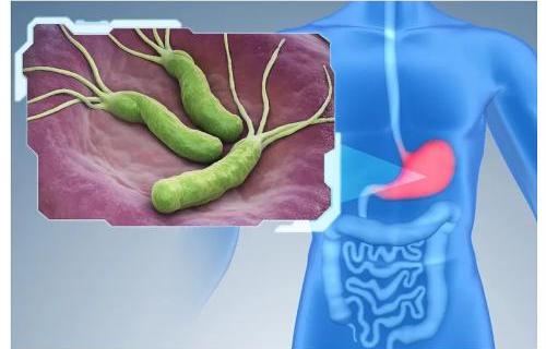 孩子反复腹痛、呕吐、厌食，要警惕幽门螺旋杆菌感染