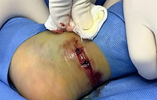 险！柳河3岁男孩被毒蛇咬伤……