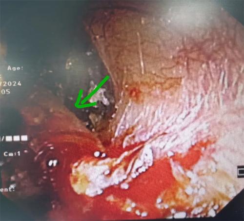 点赞！半分钟取出耳道异物