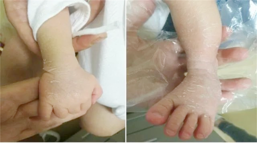 别慌，这些新生儿皮肤改变可以自行消退！