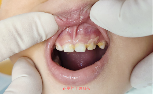 上唇系带，您了解多少？