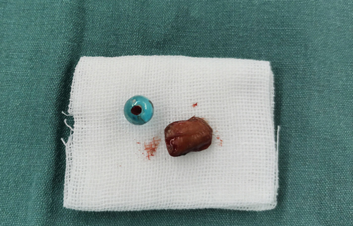 又两例！儿童鼻腔异物不容小觑！