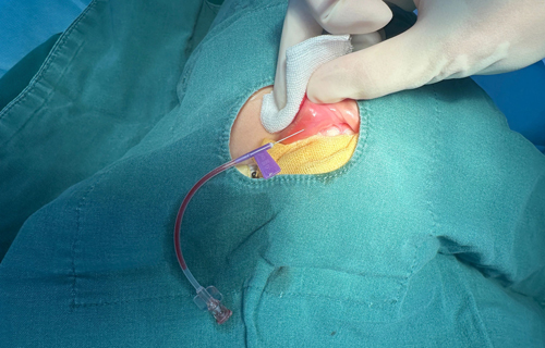 不开刀的血管焕新术：a片网站
DSA技术开启微创介入治疗新纪元