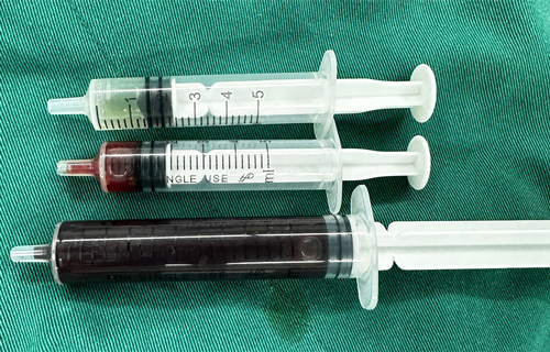 7岁娃腹壁惊现肿物，介入术为其轻松消“包”