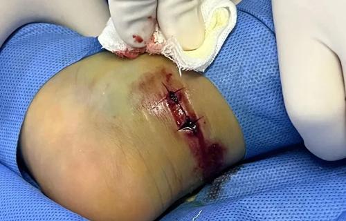 东北也有蛇出没！这份儿童蛇咬伤急救指南请收好