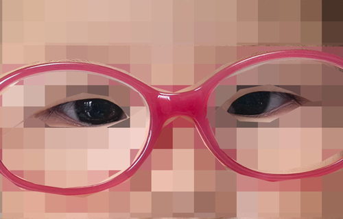 小眼镜架起大希望：半岁宝宝“免刀”矫正，秒变“正眼”娃